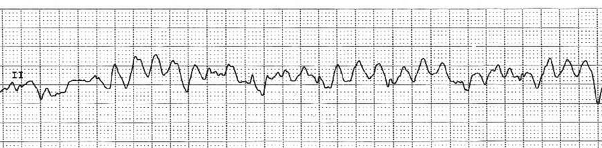 Zapis EKG z migotaniem komór 