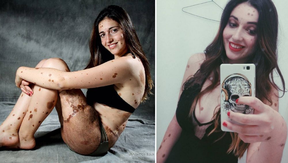 Przezywali ją "dalmatyńczyk". Utarła im nosa