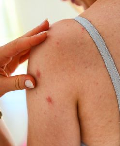 Coraz więcej zachorowań na odrę w Polsce. Politycy chcą szczepić obcokrajowców ze wschodu