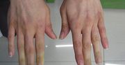 Zimne dłonie? Uważaj, twój organizm cię ostrzega