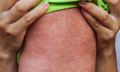 Podejrzenie odry u 6-latka. Dziecko było wcześniej szczepione