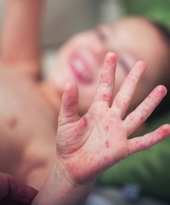 Odra w Polsce: czy to już epidemia? Brakuje szczepionek