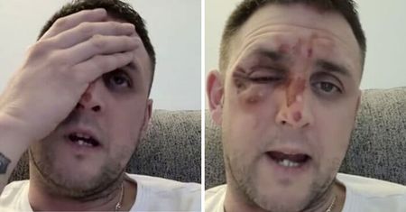Modny trik z TikTok'a poparzył mu twarz. Teraz ostrzega innych!