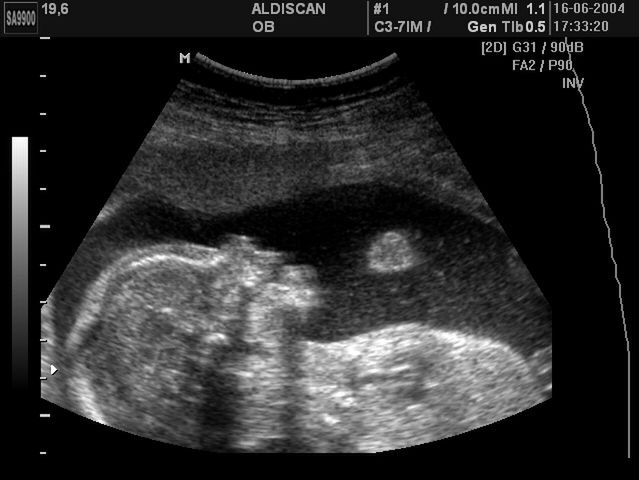 USG 19-tygodniowej ciąży 