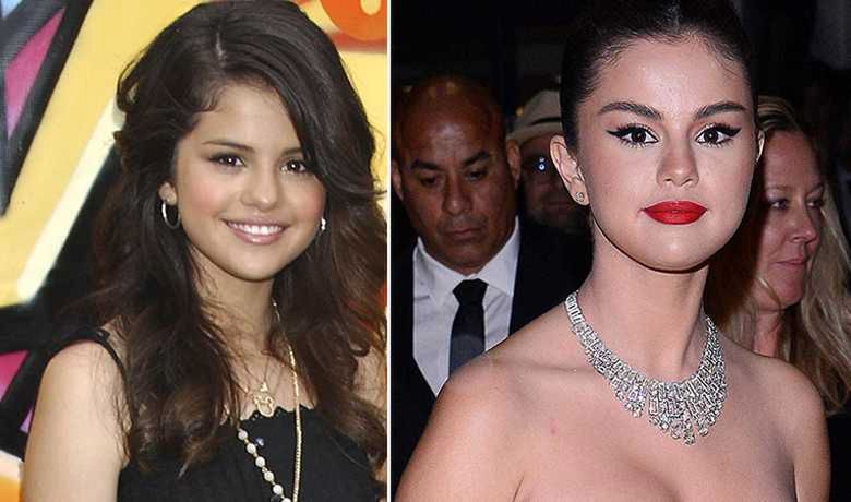 Selena Gomez przed i po zabiegu powiększającym usta