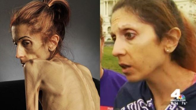 Niesamowita transformacja anorektyczki. Jeszcze do niedawna ważyła 20 kg