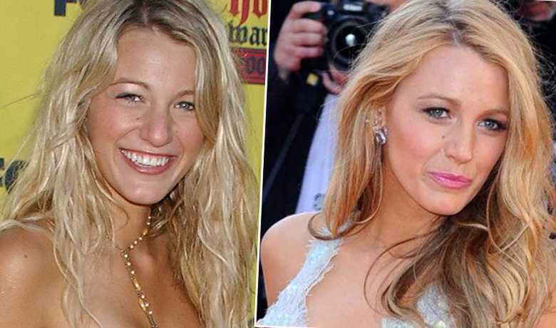 Blake Lively przed i po zabiegu powiększającym usta