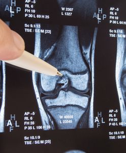 Rzepka w kolanie - choroby i leczenie
