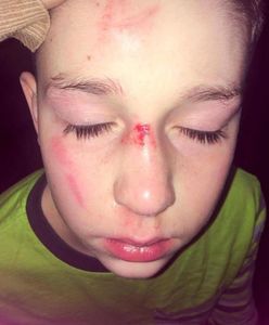 Koledzy pobili chłopca z rzadką odmianą autyzmu. Wpis mamy łamie serce