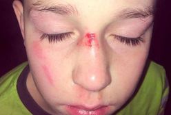 Koledzy pobili chłopca z rzadką odmianą autyzmu. Wpis mamy łamie serce