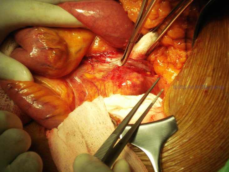 Przebieg operacji usunięcia tętniaka 