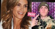 Spore zmiany na twarzy 21-letniego syna Cindy Crawford. Bolesny zabieg dał nieprawdopodobny efekt