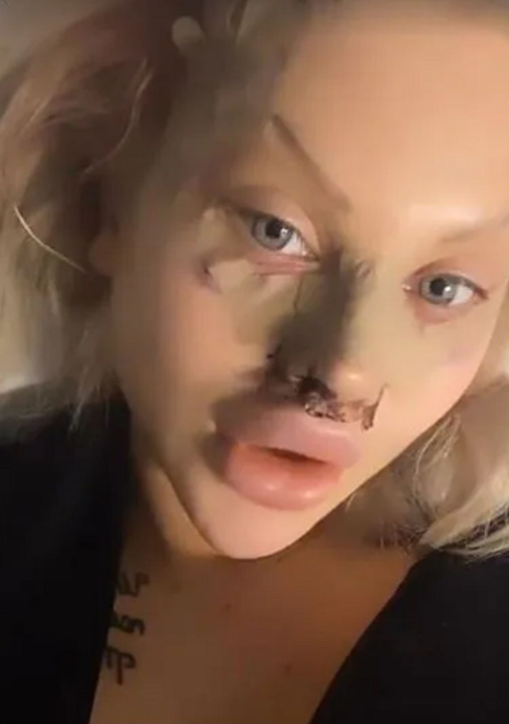 Ewelina Kubiak po operacji nosa