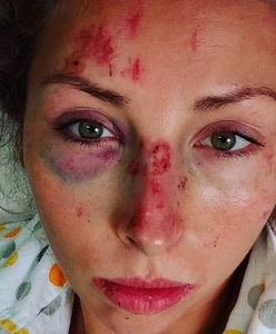 Polska olimpijka potrącona przez minibusa. Dramatyczny wypadek podczas treningu