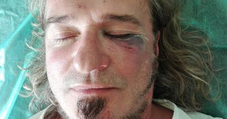 Znany wokalista brutalnie pobity. "Trzech na jednego, od tyłu, bez ostrzeżenia"