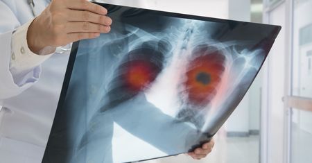 70 proc. guzów znika. Izraelscy naukowcy z rewolucyjną metodą leczenia raka