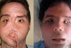 Postrzelił się w twarz