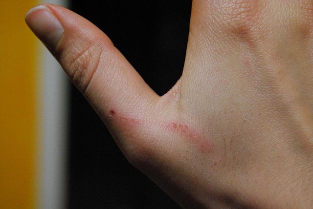 Woda utleniona jest środkiem dezynfekującym, ale używanie jej w przypadku małych zacięć jest ryzykowne.