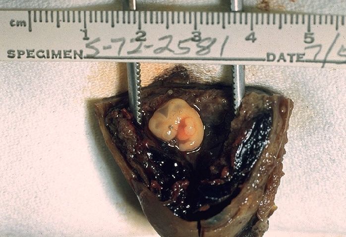 Zdjęcie zarodka z ciąży jajowodowej 