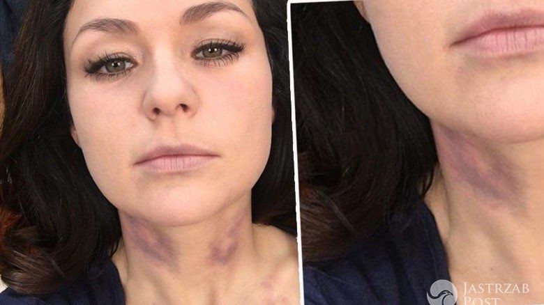 Posiniaczona Kasia Cichopek