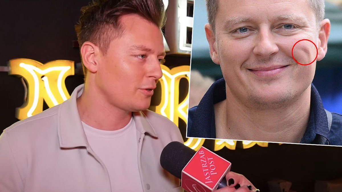 Rafał Brzozowski ma bliznę na twarzy