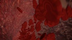 Robią ci się często siniaki? To może być małopłytkowość