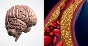 Cholesterol a mózg. Zobacz, jak na niego wpływa