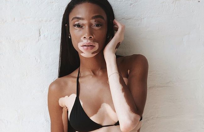 Modelka z bielactwem pozuje w bikini. Winnie Harlow jest dumna ze swojej urody