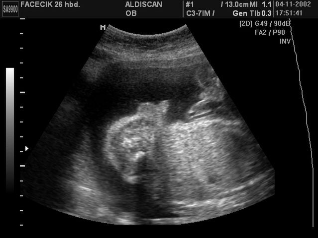Zdjęcia płodu - 26 tydzień ciąży 