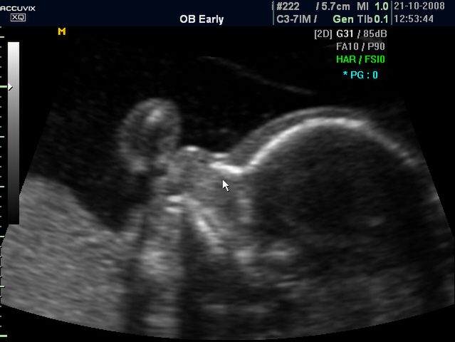 Zdjęcia płodu - 29 tydzień ciąży 