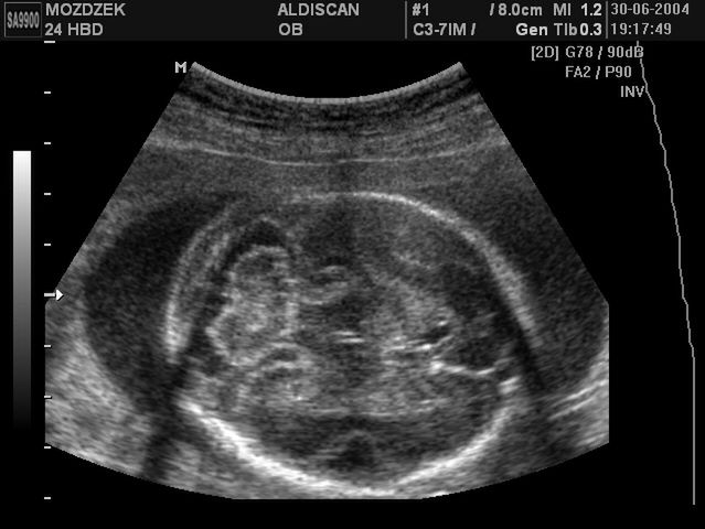 Zdjęcia płodu - 24 tydzień ciąży 
