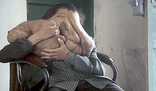 Z wyglądem "człowieka słonia" trafił do cyrku. Nieznana choroba zrobiła z niego potwora