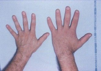 Dłoń mężczyzny z akromegalią 
