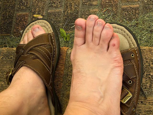 Otarcia od obuwia to nie tylko problem kobiet.