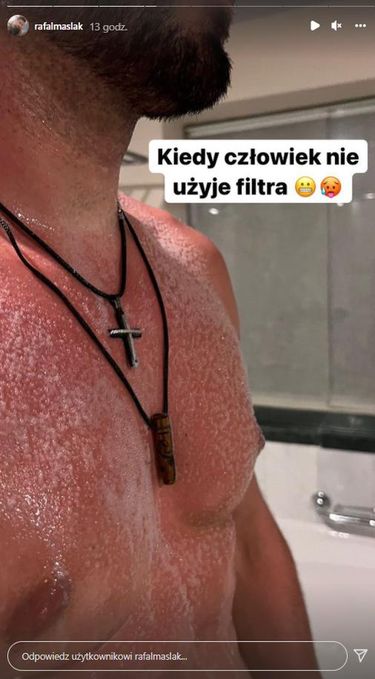 Rafał Maślak spalił się na słońcu