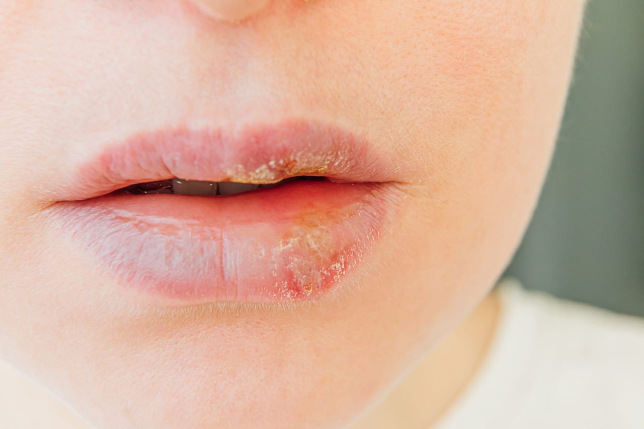 Close up of girl lips affected by herpes. Treatment of herpes infection and virus. Part of young woman face, lips with herpes affected. Beauty dermatology concept