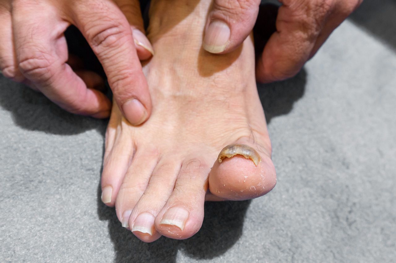 A closeup view of a man barefoot with a yellow and thick big toenail, onychomycosis, a fungal infection of toe nails.