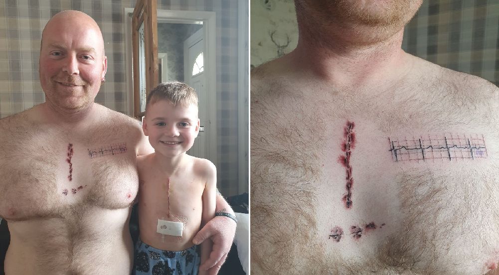 Chciał wesprzeć syna po operacji. Wytatuował sobie bliznę