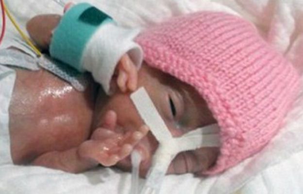 Emilia Grabarczyk to najmniejsze dziecko na świecie! Lekarze nie dawali jej szans na przeżycie