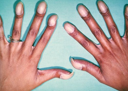 Zmienione chorobowo dłonie 