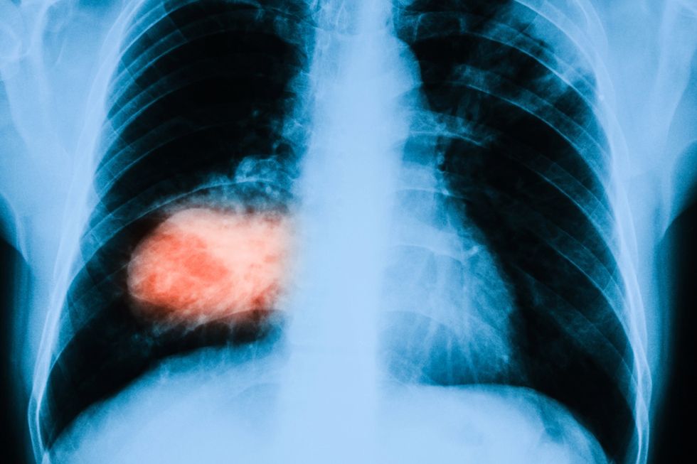 Chorzy na raka płuc pacjentami drugiej kategorii? "Jesteśmy rozczarowani"