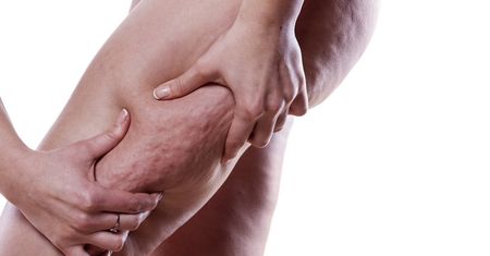 Cellulit — czym jest i skąd się bierze? Rodzaje cellulitu