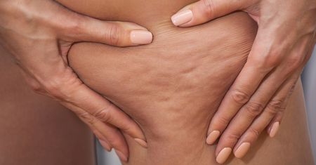 Uciążliwy cellulit. Rozpocznij walkę ze skórką pomarańczową już dziś