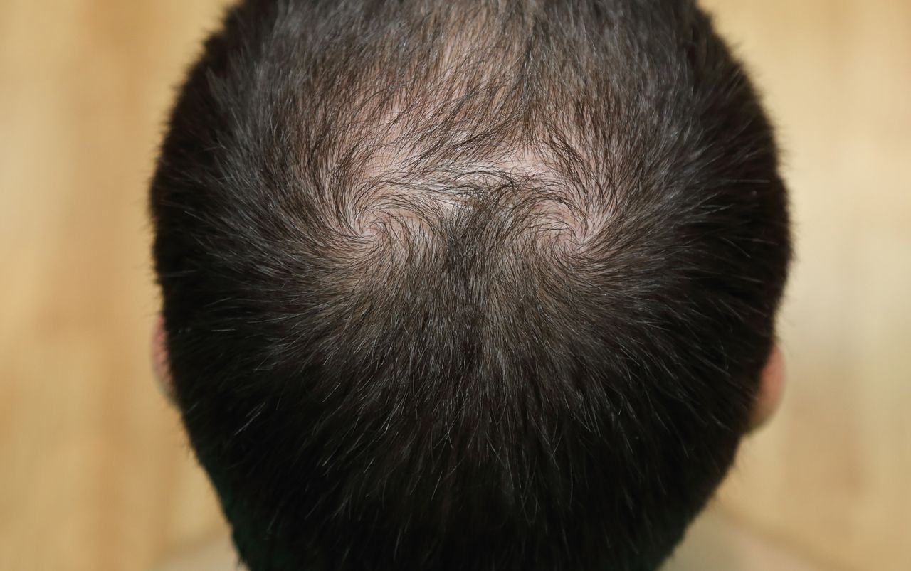 Koreańczycy odkryli lek na łysienie. Wspaniała wiadomość dla wielu mężczyzn