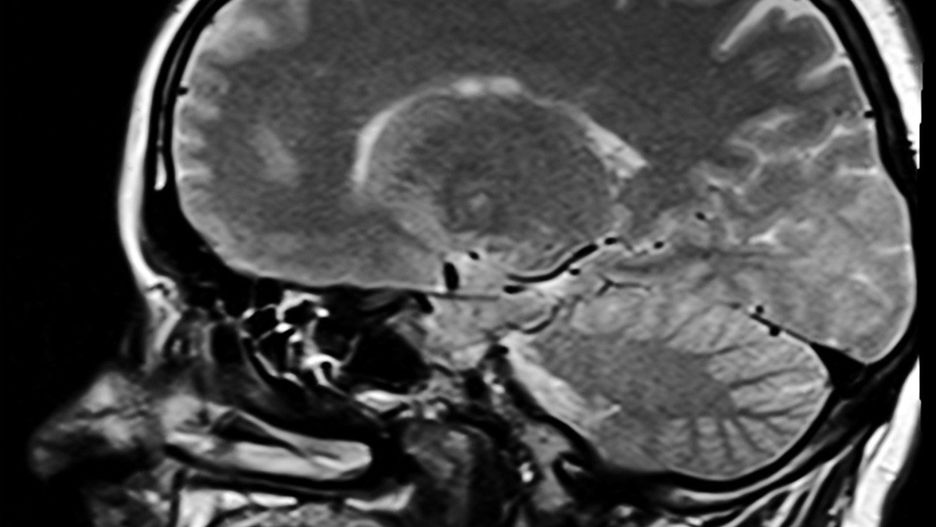 Pigułki antykoncepcyjne wpływają na wielkość podwzgórza