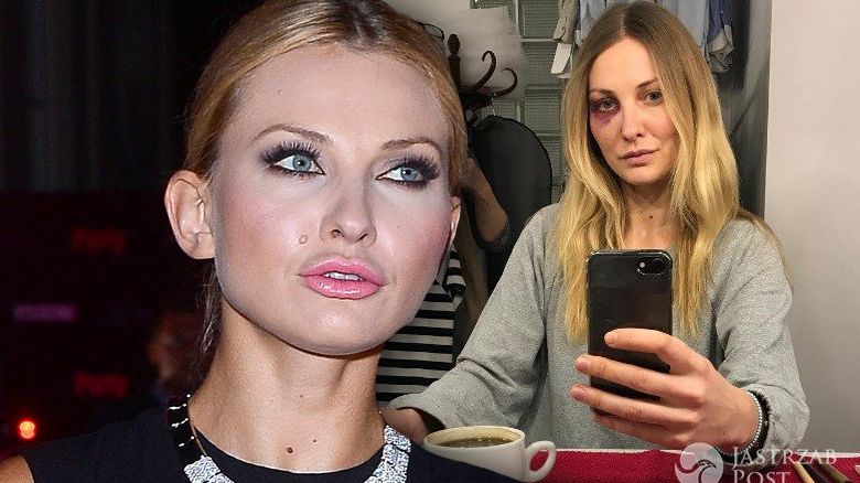 Joanna Moro z podbitym okiem