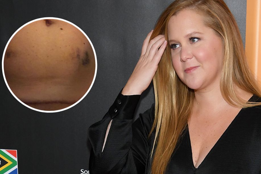 Amy Schumer poddaje się in vitro. Pokazała brzuch po zastrzykach