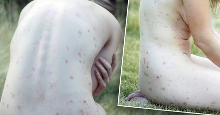 Gwiazda wielkiego przeboju ma łuszczycę. Choroba zaatakowała jej całe ciało. Odważne zdjęcia