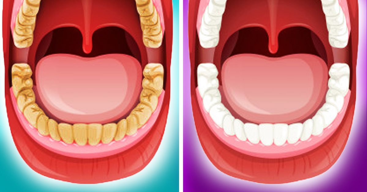 6 naturalnych sposobów na wybielenie zębów. Efektywnie usuniesz kamień nazębny
