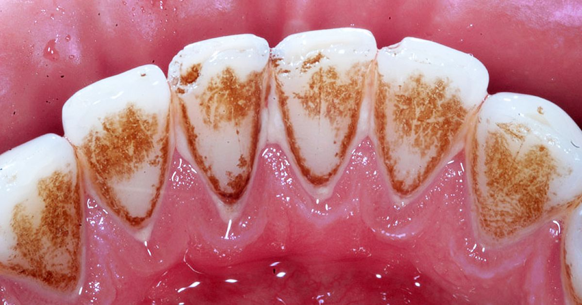 Trzy sposoby na usunięcie kamienia z zębów w domu. Bardzo skuteczne!